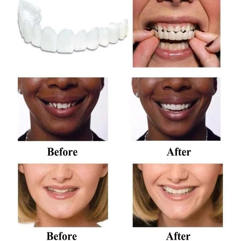 Snap on Smile Teeth Whitening veneers (Perfect Smile)